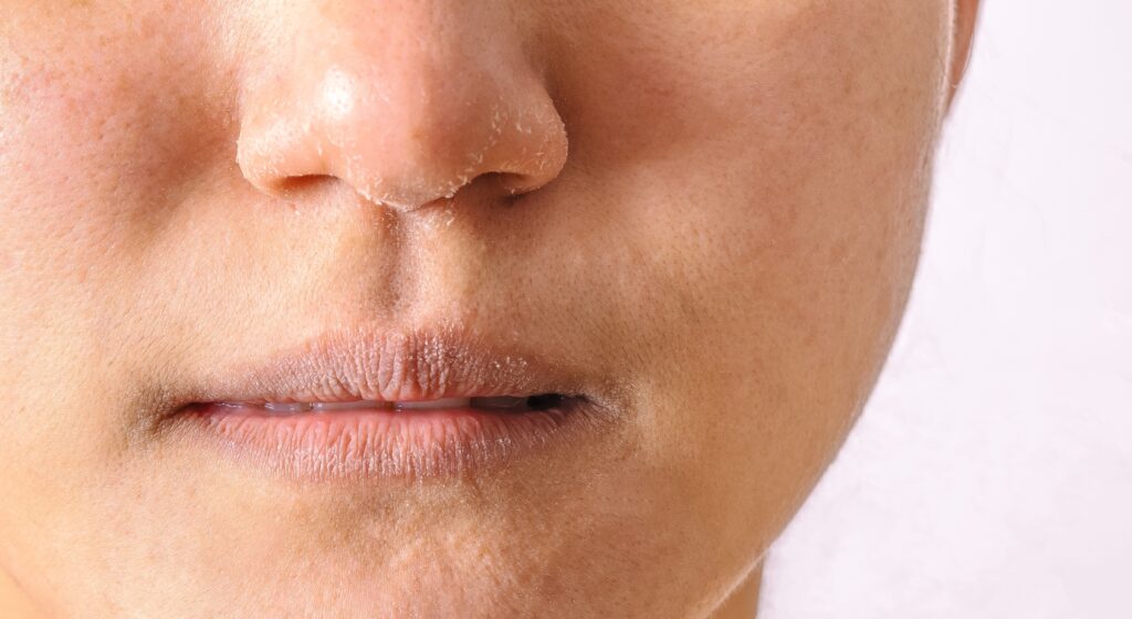 Pelle secca e screpolata in autunno: cause, rimedi e prodotti consigliati