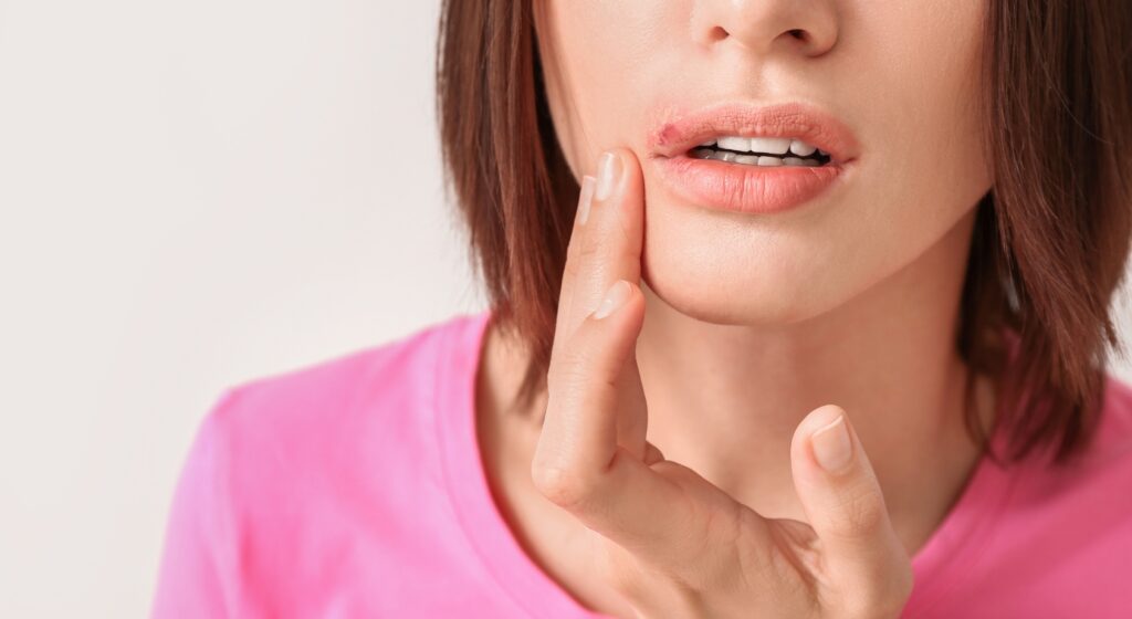 Herpes labiale: perché peggiora in inverno e come tenerlo sotto controllo